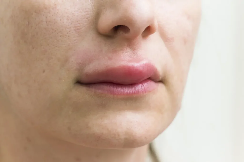 Six heart disease symptoms visible on lips