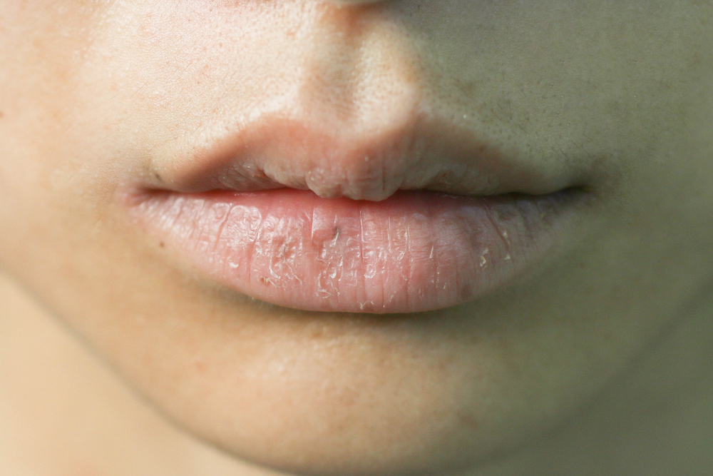 Six heart disease symptoms visible on lips