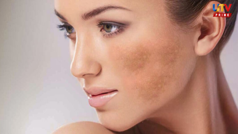 dark-spots-liver-disease-symptoms-link