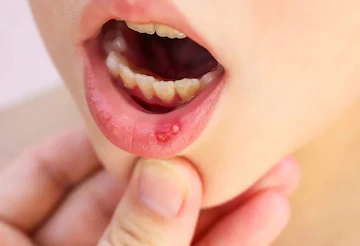 oral-cancer-reasons-symptoms-non-smokers
