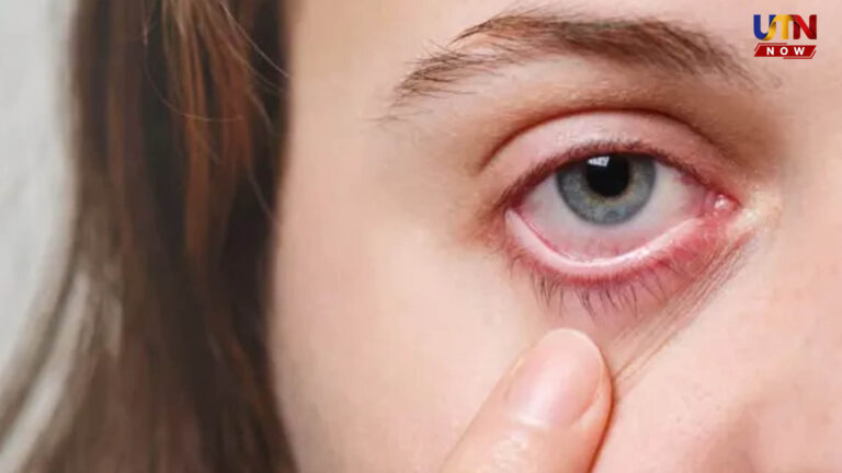 fatty-liver-disease-signs-in-eyes-warning